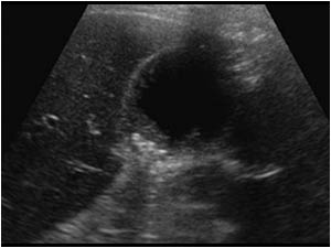 Transverse image of the gallbladder with sludge and small stones in the gallbladder.