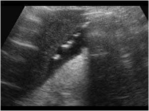 Longitudinal image of the lowerpole of the liver with peritoneal fluid and reflective structures with acoustic shadowing.
The highly reflective non gravity dependent echos in the gallbladder and the peritoneal cavity are caused by air.