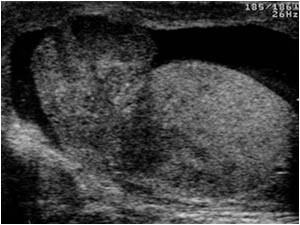 Longitudinal image of the left scrotum with an enlarged inhomogeneous epididymis and testicle, reactive hydrocele