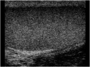 Longitudinal image of the right scrotum with a normal testis