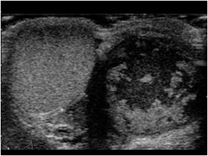 Transverse image of the right scrotum with a normal testis, but with an irregular peritesticular fluid filled mass representing caseous necrosis