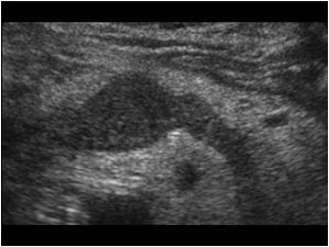 Transverse image of an abnormal portal confluence and splenic vein filled with a hypo-echoic intraluminal mass.