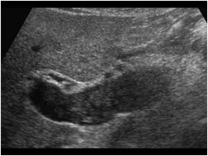 Transverse image of the portal vein with the same hypoechoic slightly lobulated hypo-echoic intraluminal mass.