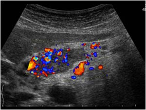 Transverse color doppler image of the portal confluence demonstrating flow in the intraluminal mass.