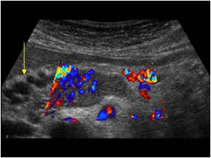 Transverse color doppler image of the portal confluence demonstrating flow in the intraluminal mass. There are tortuous cystic like structures visable next to the portal confluence.