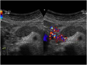 Transverse color doppler image shows flow in the tortuous cystic like structures next to the portal confluence. They represent collateral veins. No primary tumor could be demonstrated with ultrasound.
