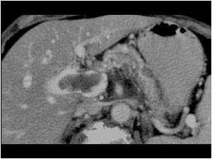 CT scan demonstrating the mass in the portal vein and portal confluence.