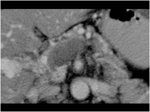 CT scan demonstrating tumor in the splenic confluence and flow in the collateral veins.