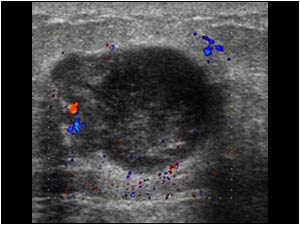 Color doppler shows only vascularity in part of the lesion