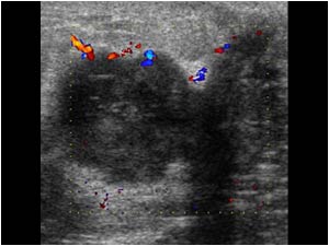 Color doppler image of the same lesion with peripheral vascularity and connection to the 
nipple.