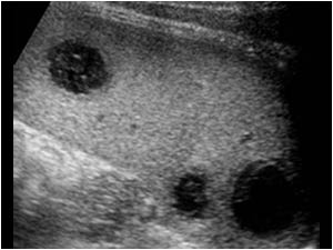 Transverse image of an enlarged spleen with multiple hypoechoic round lesions