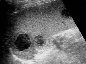 Longitudinal image of an enlarged spleen with multiple hypoechoic round lesions