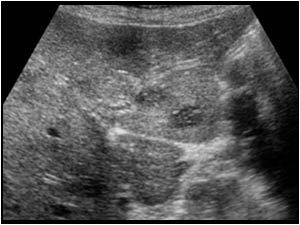 Left liver lobe with hypoechoic lesions transverse view

The lesions in the liver and the spleen are multiple hepatic and splenic abscesses.
The girl had serological evidence of cat scratch disease. Cat scratch disease is an infection caused by a gram-