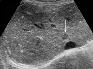 Only a solitairy liver lesion can be identified