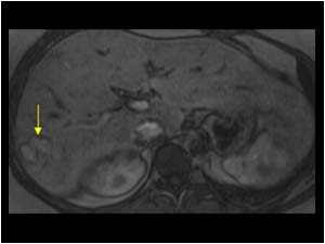 Liver hemangioma MRI
