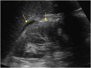 Longitudinal image of the kidney with a hyperechoic rim and a perirenal effusion