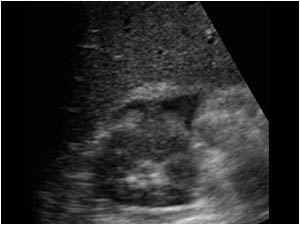 Transverse image of the kidney with a hyperechoic rim and a perirenal effusion