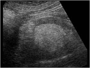 Detail of the mass lesion with very high echogenicity