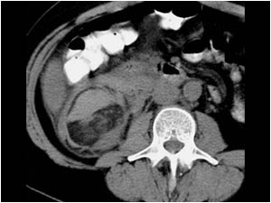 CT scan of the mass lesion showing the characteristic low density of fat