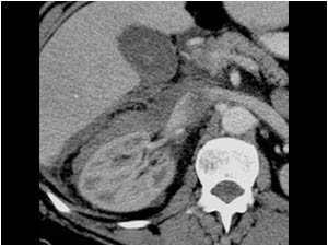 CT scan of the right kidney with a perirenal and retroperitoneal hemorrhage