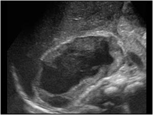 Longitudinal image of the mass cranial to the right kidney