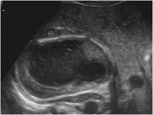 Transverse image of the mass cranial to the right kidney