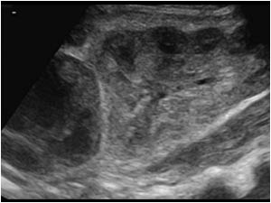 Longitudinal image of the normal right kidney and the mass