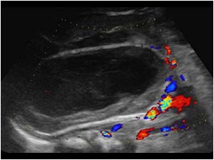The mass shows no vascularity with color doppler