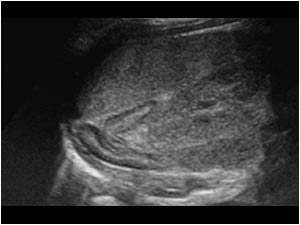 Longitudinal image of the normal left adrenal