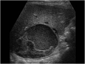 Transverse image of an adrenal hemorrhage in a 39 year old female (without tumor)