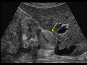 Transverse image of the right renal vein and inferior vena cava with soft tissue structures