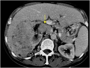 CT scan at the level of the right reanal vein with tumor thrombus in the renal vein and the inferior vena cava