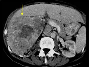 CT scan showing the large renal cell tumor

Diagnosis: Renal cell carcinoma invading the renal vein and inferior vena cava

Renal cell tumors in the right kidney invade the inferior vena cava through the renal vein sooner than renal cell tumors on the
