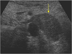 Transverse image with a dilatated left renal vein filled with tumor thrombus