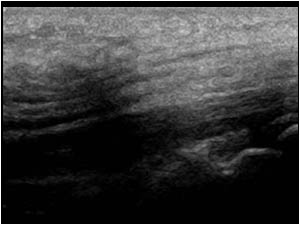 Longitudinal image of the median nerve in the carpal tunnel showing compression and calibre change of the massively thickened nerve.