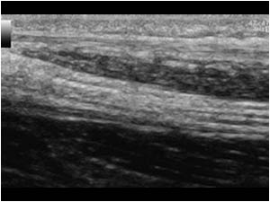 Longitudinal image of the median nerve in the distal lower arm. The aspect returns to normal.