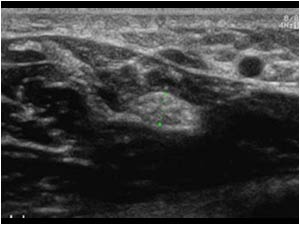 Transverse image of the median nerve in the distal lower arm. The aspect returns to normal.