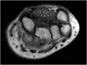 Transverse MRI image of the median nerve also showing the massively thickened nerve with normal fascicles interspersed with fatty material.