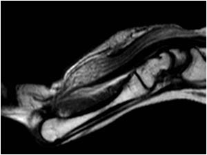 Longitudinal MRI image of the median nerve also showing the massively thickened nerve with normal and thickened fascicles interspersed with fatty material and carpal tunnel compression.