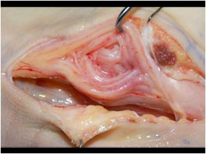 Longitudinal image of the thickened nerve with slightly thickened fascicles interspersed with fatty tissue made during operation.