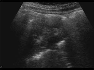Longitudinal image of the right kidney with an echogenic rim around the kidney. The kidney is difficult to visualize.