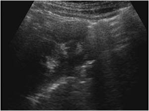 Longitudinal image of the right kidney with highly reflective structures at the lower pole