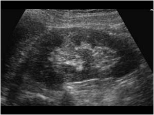 Longitudinal image of the left kidney without any abnormality