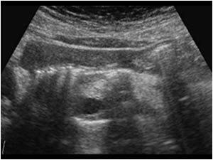 Transverse image of the pancreas. The head and a part of the body of the pancreas are obscured by the same echogenic structures.