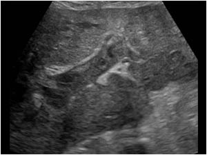 Transverse image of the left portal vein with an intraluminal structure