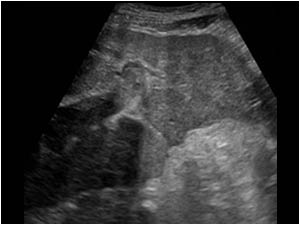 Another image of the liver showing an intraluminal structure in the portal vein and an irregular liver contour