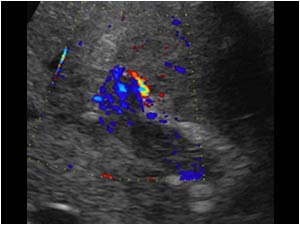Detail of the portal vein shows no normal intraluminal flow, but color doppler signals suggestive of flow in the intraluminal mass