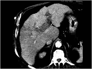 CT image of the same patient portal phase

The CT scan confirmed the irregular inhomogeneous aspect of the liver, but was not conclusive about the presence of a tumor or tumor vascularity in the portal veins.
Because the initial ultrasound examination
