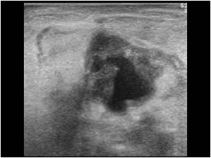 Irregular cystic mass with a thick irregular wall and desmoplastic reaction around the cyst