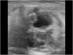 Part of the cystic mass with smaller cysts